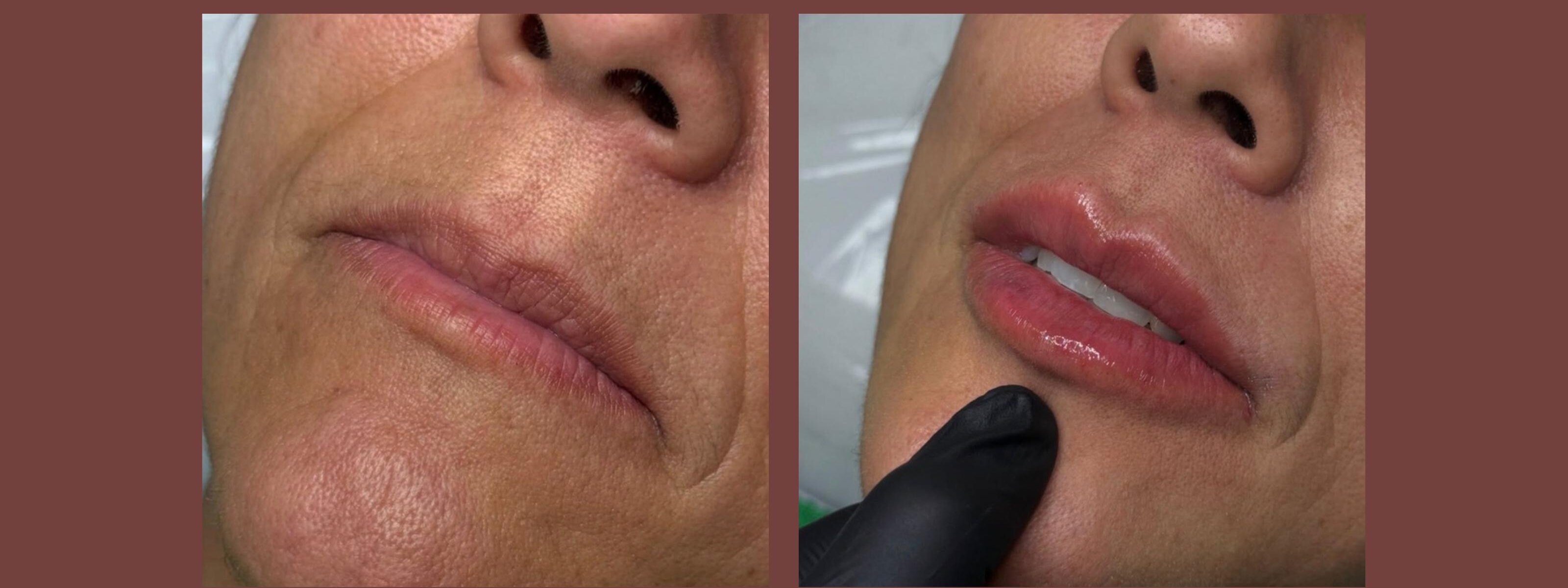 Antes e depois · Rejuvenescimento labial