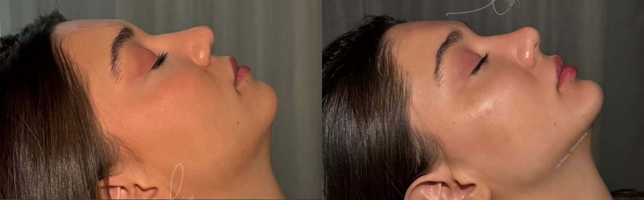 Antes e depois · Harmonização facial completa