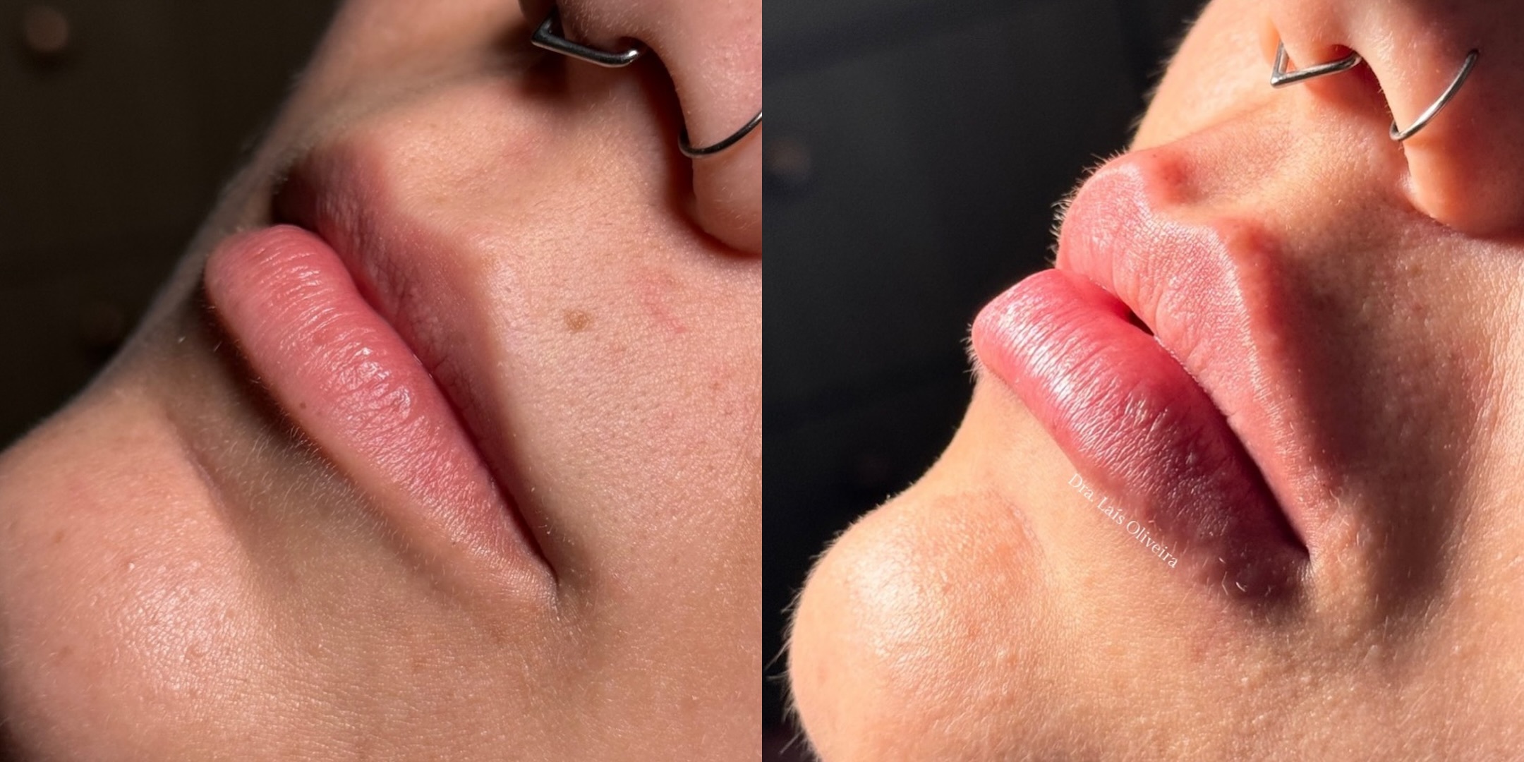 Antes e depois · Preenchimento labial
