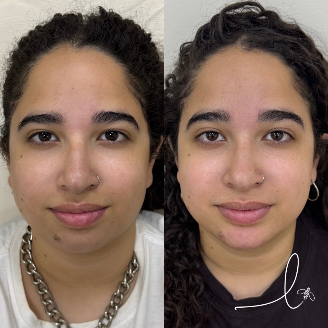 Antes e depois · Preenchimento de mento e lábios